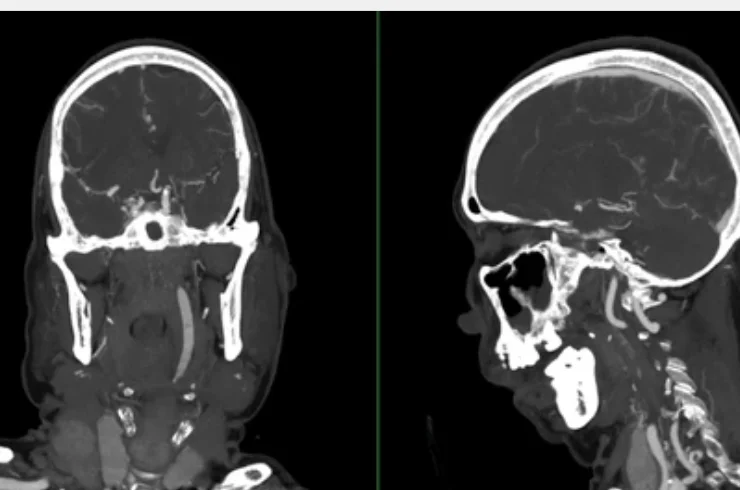CT Angiography-