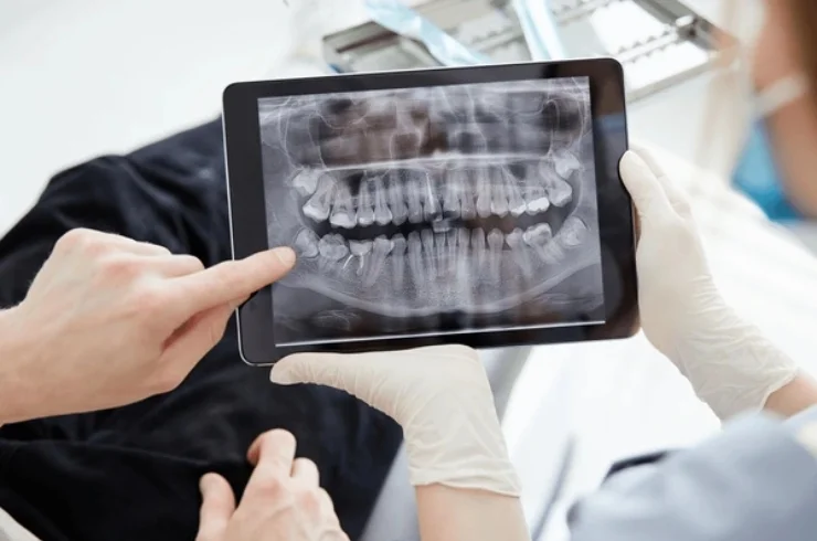 Dental X-rays and Digital OPG