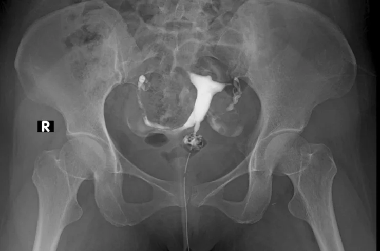 HSG (Hysterosalpingography)