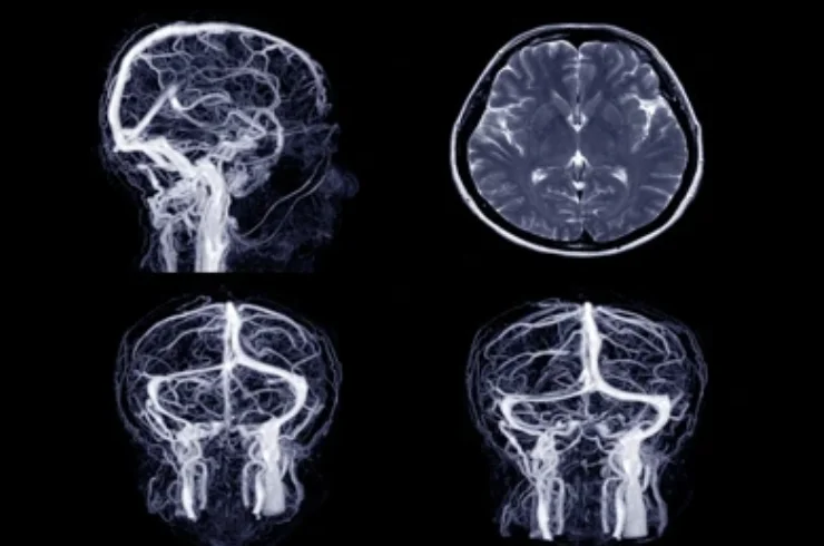 MR Angiography and Venogram