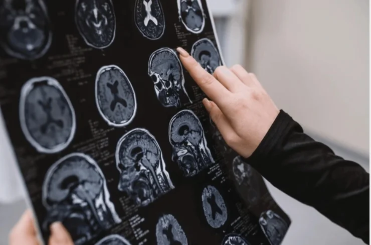 MRI Stroke Study